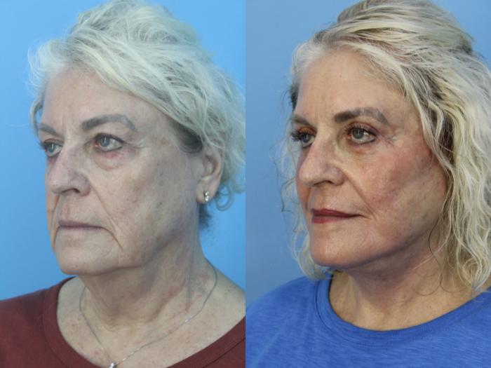 Before & After Facial Liposuction Case 459 Left Oblique View in West Des Moines & Ames, IA