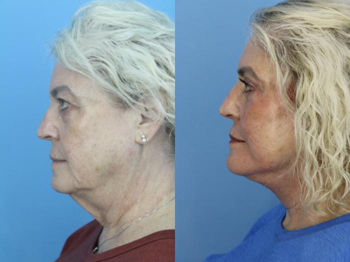 Before & After Blepharoplasty (Upper Eyelid Lift) Case 459 Left Side View in West Des Moines & Ames, IA