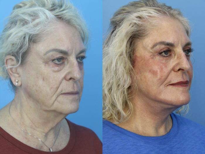 Before & After Facial Liposuction Case 459 Right Oblique View in West Des Moines & Ames, IA