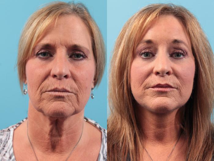 Before & After Facial Liposuction Case 46 View #1 View in West Des Moines, IA