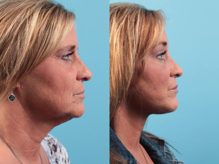 Before & After Facelift Case 46 View #3 View in West Des Moines, IA