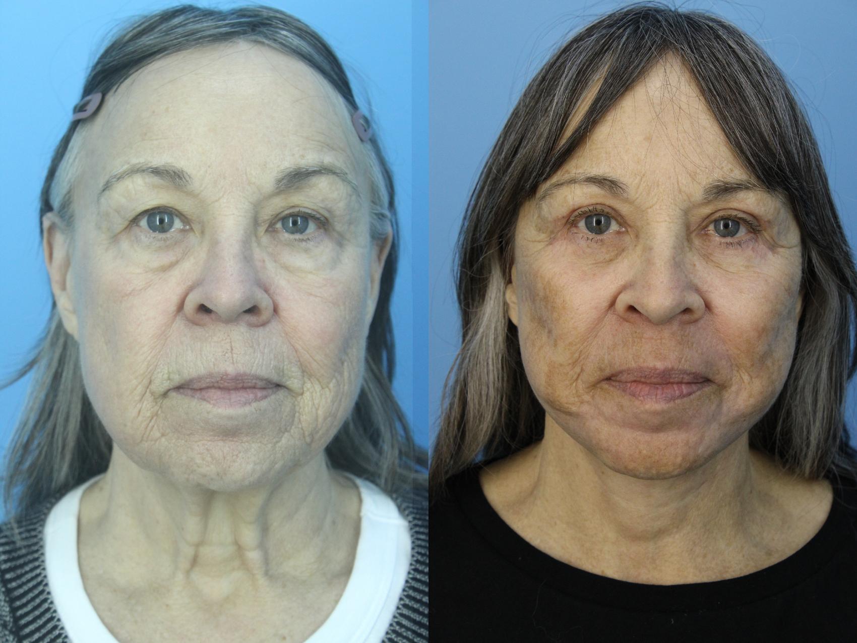 Before & After Facelift Case 463 Front View in West Des Moines & Ames, IA