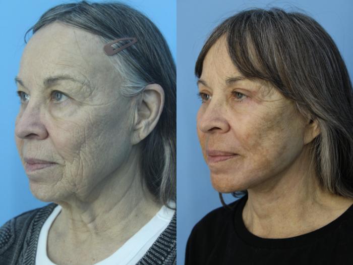 Before & After Facelift Case 463 Left Oblique View in West Des Moines & Ames, IA