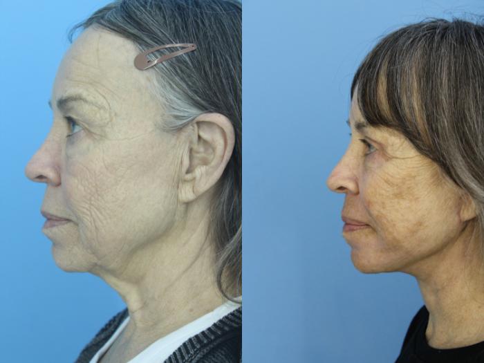 Before & After Facelift Case 463 Left Side View in West Des Moines & Ames, IA