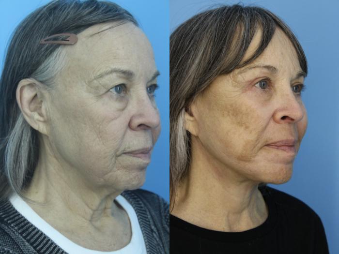 Before & After Facelift Case 463 Right Oblique View in West Des Moines & Ames, IA