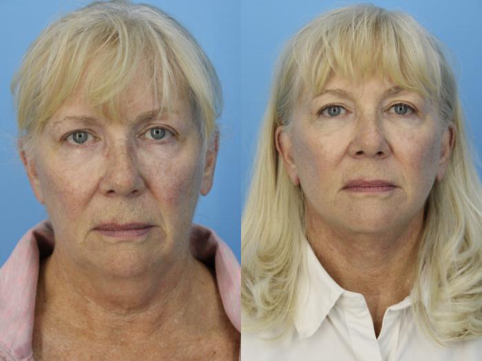 Before & After Facial Liposuction Case 465 Front View in West Des Moines & Ames, IA