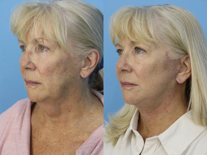 Before & After Facial Liposuction Case 465 Left Oblique View in West Des Moines & Ames, IA