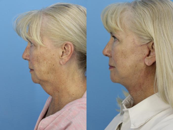 Before & After Facial Liposuction Case 465 Left Side View in West Des Moines & Ames, IA