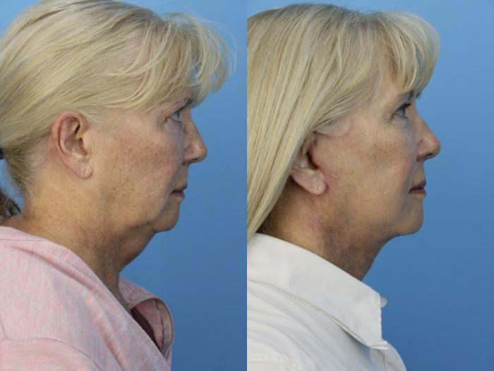 Before & After Facelift Case 465 Right Side View in West Des Moines & Ames, IA