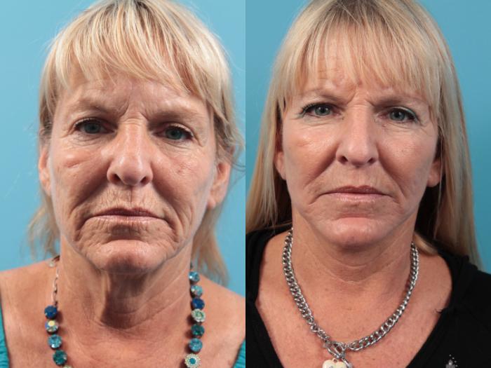 Before & After Laser Treatments Case 47 View #1 View in West Des Moines, IA