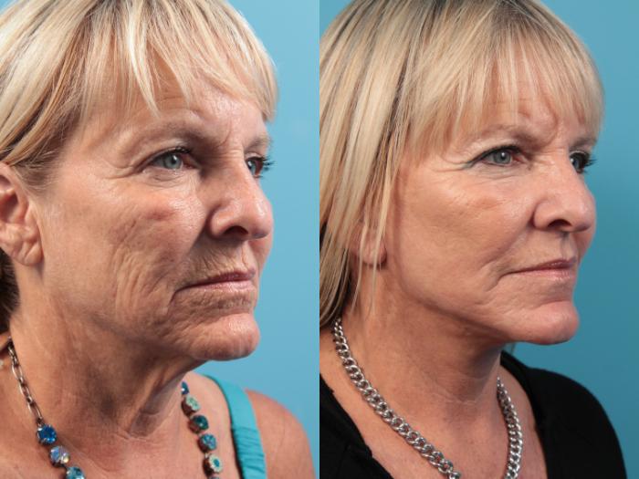 Before & After Facial Liposuction Case 47 View #2 View in West Des Moines & Ames, IA