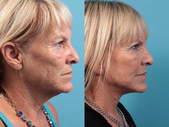 Before & After Facelift Case 47 View #3 View in West Des Moines & Ames, IA