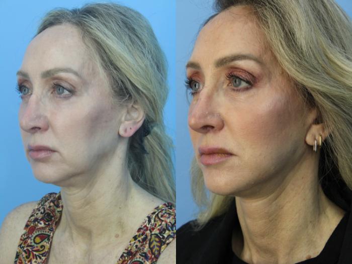 Before & After Facial Liposuction Case 472 Left Oblique View in West Des Moines & Ames, IA