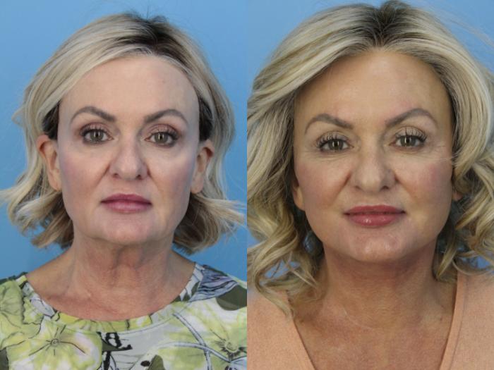 Before & After Facelift Case 473 Front View in West Des Moines & Ames, IA