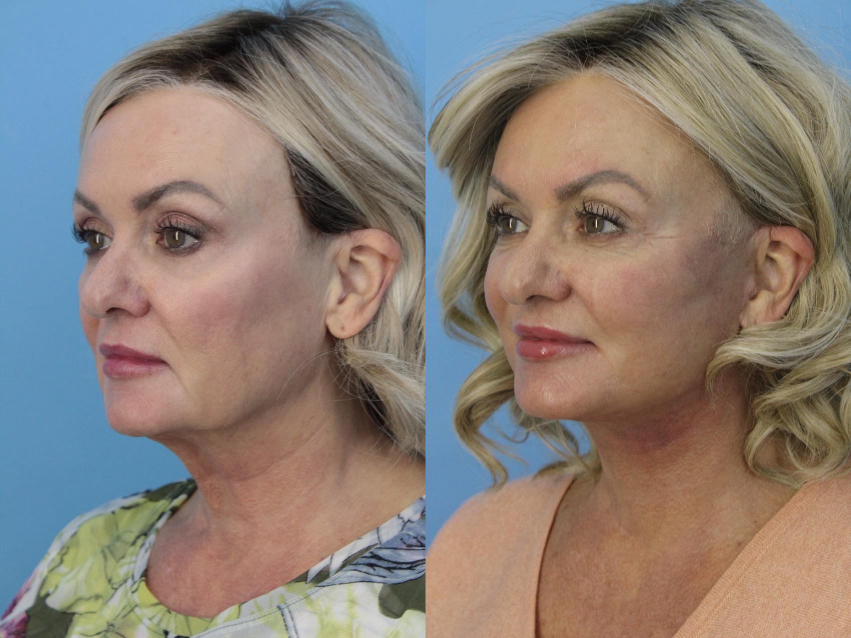 Before & After Facelift Case 473 Left Oblique View in West Des Moines & Ames, IA