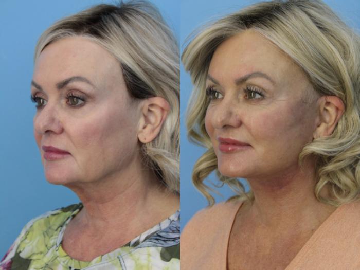 Before & After Facelift Case 473 Left Oblique View in West Des Moines & Ames, IA