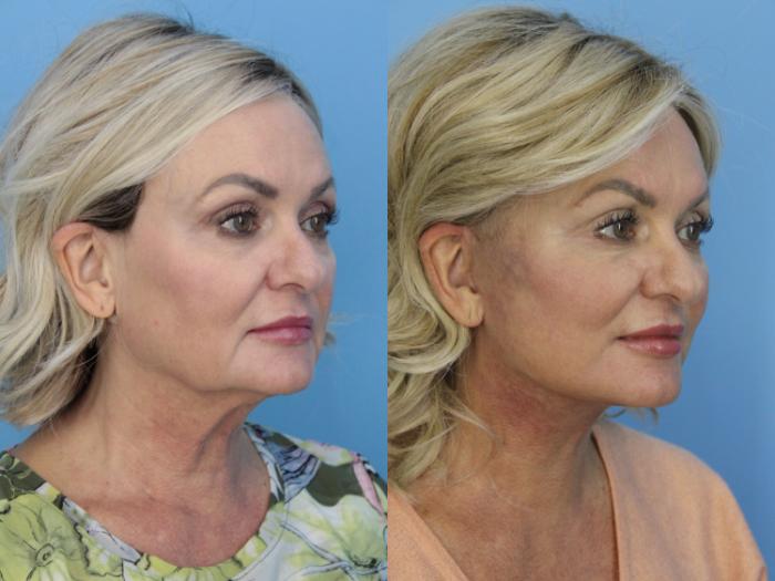 Before & After Facelift Case 473 Right Oblique View in West Des Moines & Ames, IA