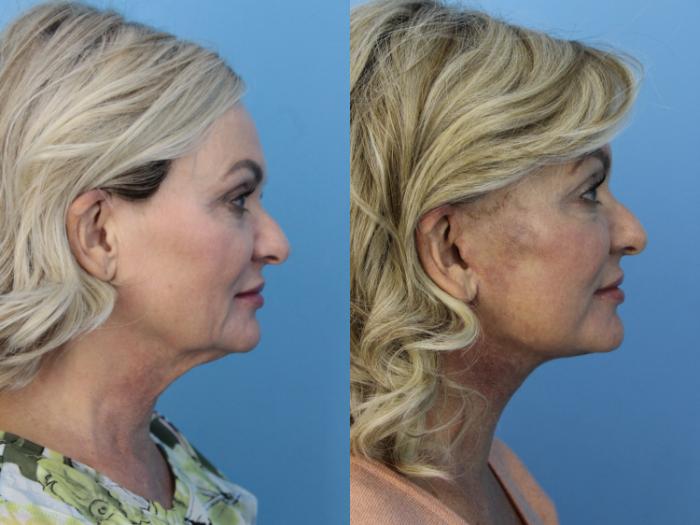 Before & After Facelift Case 473 Right Side View in West Des Moines & Ames, IA