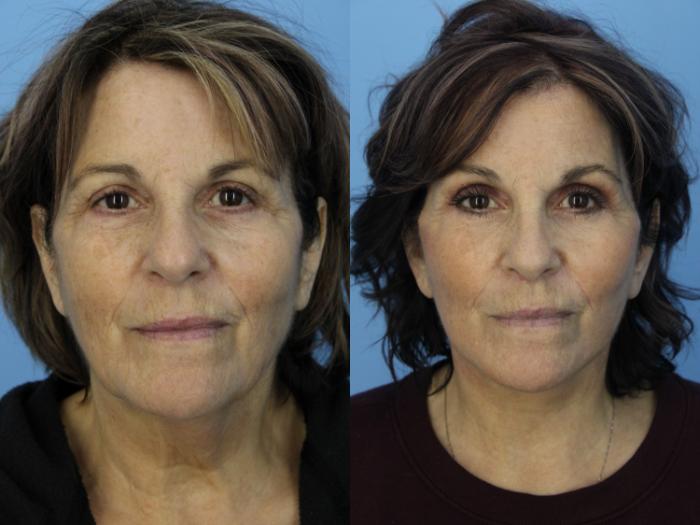 Before & After Facelift Case 474 Front View in West Des Moines & Ames, IA