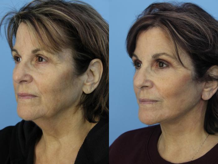 Before & After Facelift Case 474 Left Oblique View in West Des Moines & Ames, IA