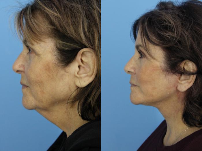 Before & After Facelift Case 474 Left Side View in West Des Moines & Ames, IA