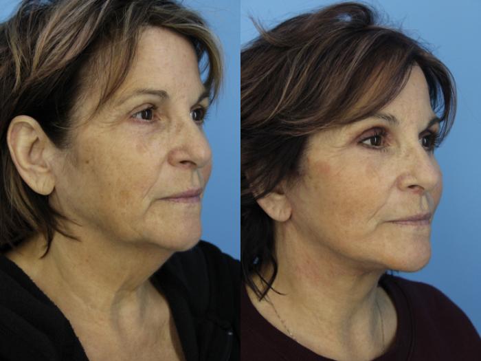 Before & After Facelift Case 474 Right Oblique View in West Des Moines & Ames, IA