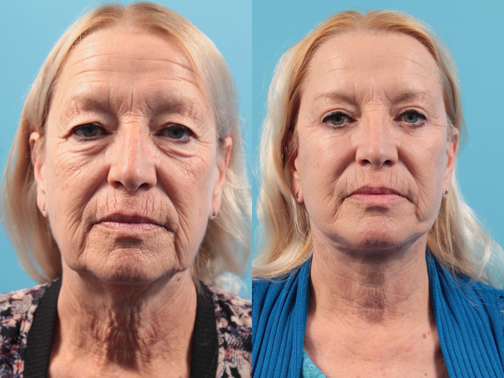 Before & After Facial Liposuction Case 48 View #1 View in West Des Moines, IA