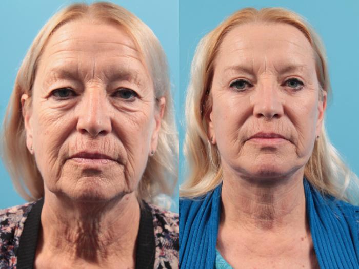 Before & After Blepharoplasty (Lower, Under Eyes) Case 48 View #1 View in West Des Moines, IA