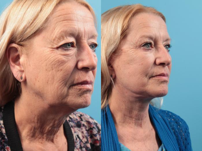 Before & After Blepharoplasty (Upper Eyelid Lift) Case 48 View #2 View in West Des Moines & Ames, IA