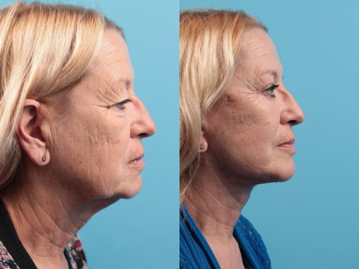 Before & After Blepharoplasty (Upper Eyelid Lift) Case 48 View #3 View in West Des Moines & Ames, IA