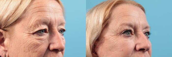 Before & After Facelift Case 48 View #4 View in West Des Moines & Ames, IA