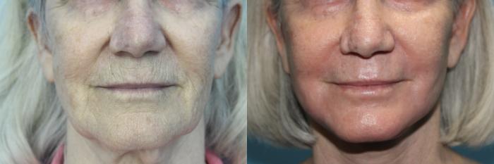 Before & After Facial Liposuction Case 481 Front #2 View in West Des Moines & Ames, IA