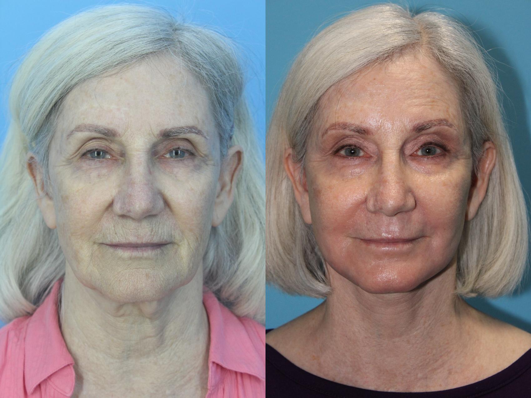 Before & After Facelift Case 481 Front View in West Des Moines & Ames, IA