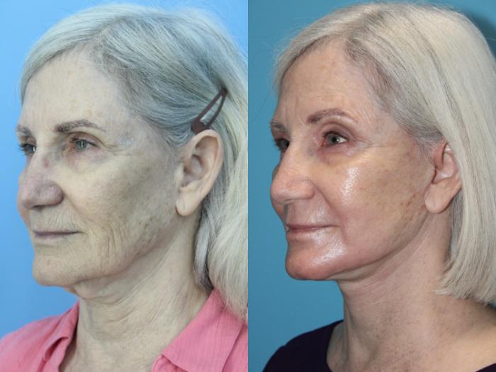 Before & After Facelift Case 481 Left Oblique View in West Des Moines & Ames, IA