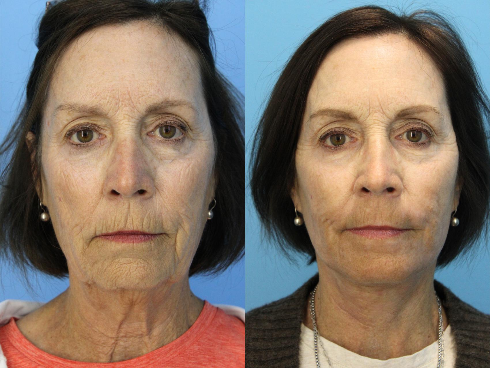 Before & After Facelift Case 494 Front View in West Des Moines & Ames, IA