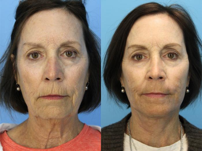 Before & After Laser Resurfacing Treatments Case 494 Front View in West Des Moines & Ames, IA