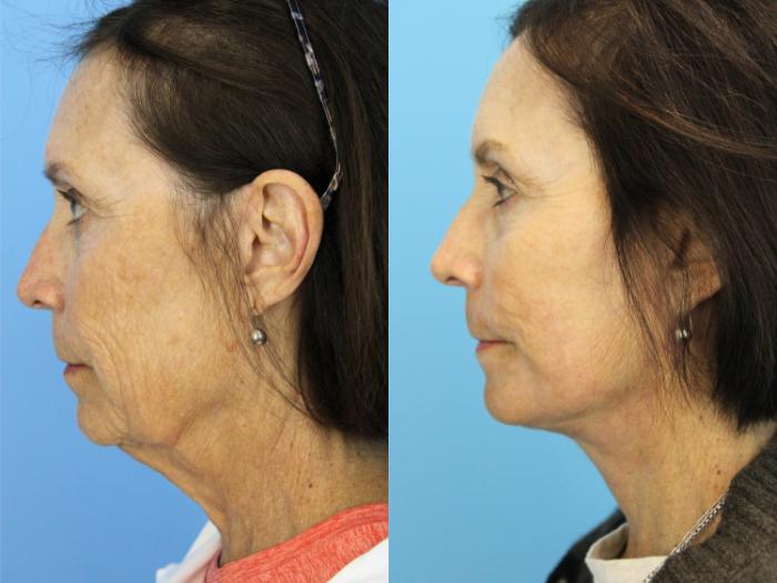 Before & After Laser Resurfacing Treatments Case 494 Left Side View in West Des Moines & Ames, IA