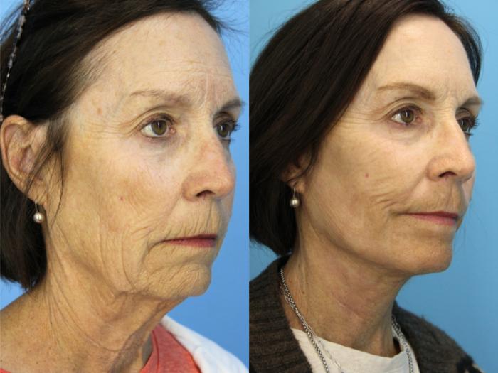 Before & After Laser Resurfacing Treatments Case 494 Right Oblique View in West Des Moines & Ames, IA