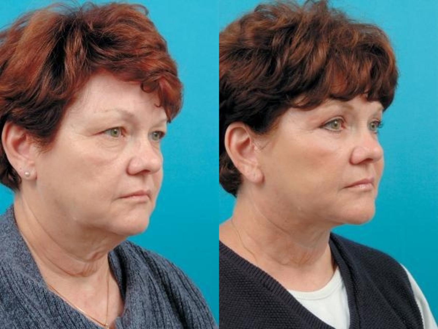 Before & After Facelift Case 5 Right Oblique View in West Des Moines & Ames, IA