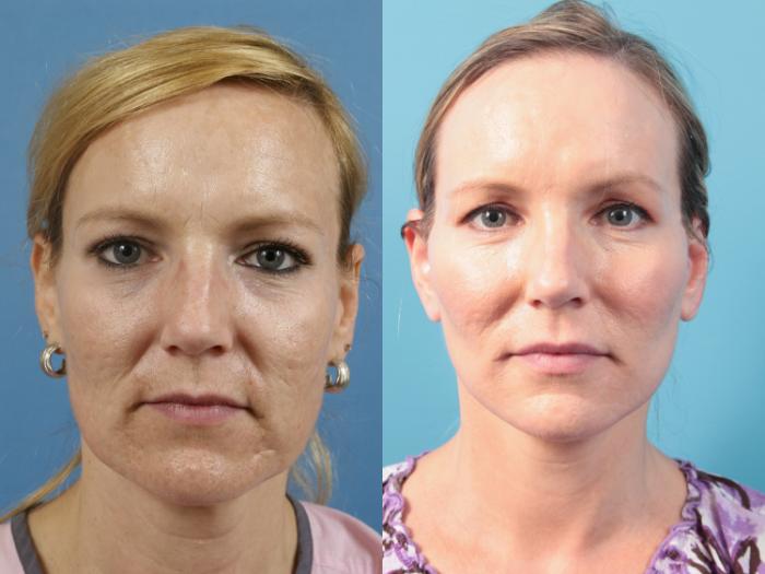 Before & After Facelift Case 52 View #1 View in West Des Moines & Ames, IA