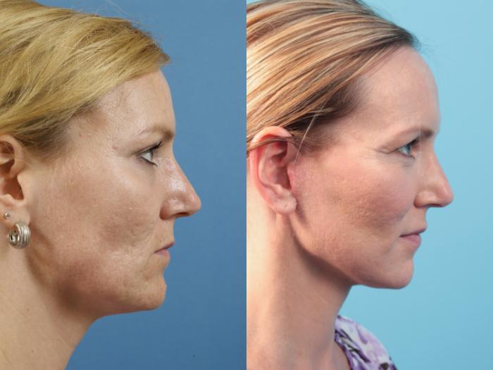 Before & After Facelift Case 52 View #2 View in West Des Moines & Ames, IA