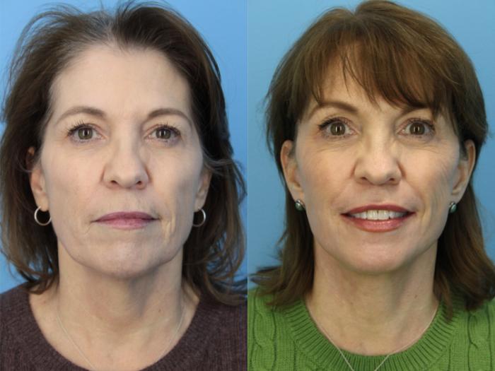Before & After Laser Resurfacing Treatments Case 528 Front View in West Des Moines & Ames, IA