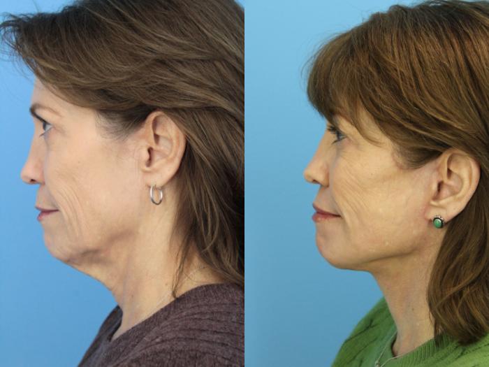 Before & After Laser Resurfacing Treatments Case 528 Left Side View in West Des Moines & Ames, IA