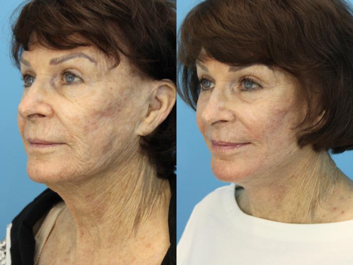 Before & After Facelift Case 534 Left Oblique View in West Des Moines & Ames, IA