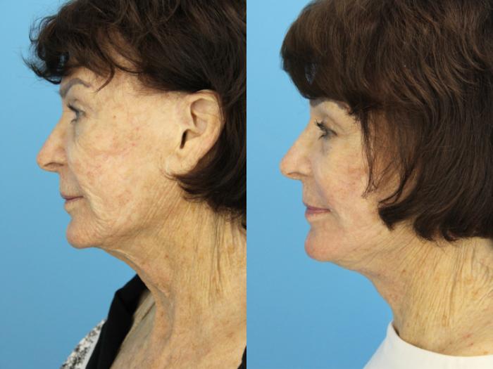 Before & After Facelift Case 534 Left Side View in West Des Moines & Ames, IA