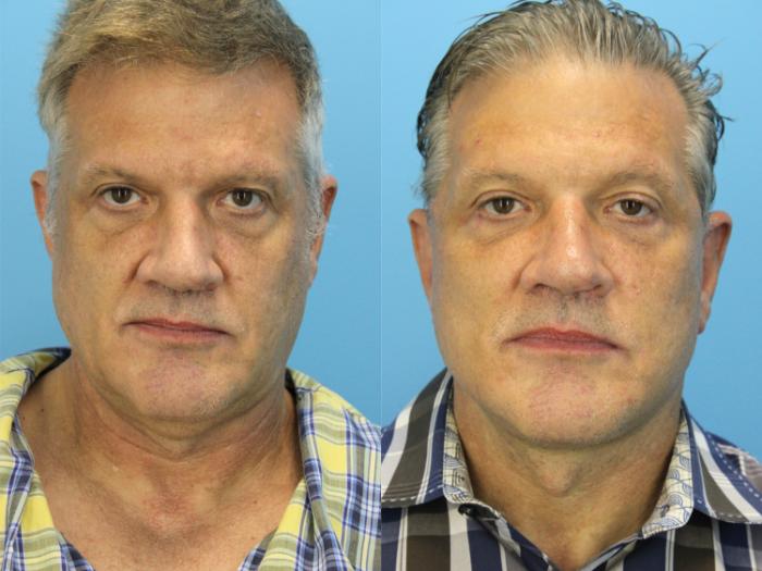 Before & After Facial Liposuction Case 535 Front View in West Des Moines & Ames, IA