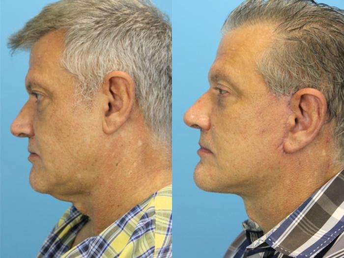 Before & After Facial Liposuction Case 535 Left Side View in West Des Moines & Ames, IA