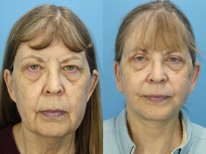 Before & After Facelift Case 539 Front View in West Des Moines & Ames, IA
