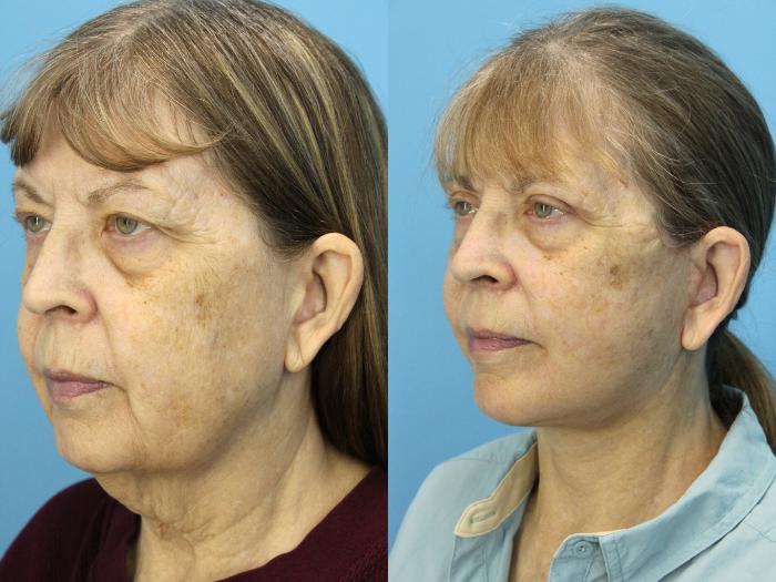 Before & After Facelift Case 539 Left Oblique View in West Des Moines & Ames, IA