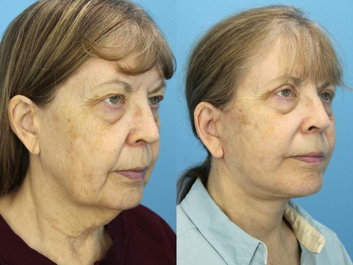 Before & After Facelift Case 539 Right Oblique View in West Des Moines & Ames, IA